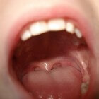 Pijn in de tong: BMS (Brandende mond syndroom)