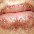 Verbrande lippen door zon of eten: behandeling en zelfzorg