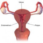 Baarmoederpoliep: symptomen, oorzaak en behandeling
