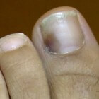 Blauwe nagels of blauwe nagel: oorzaken en wat te doen?