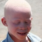 Albinisme: Hermansky-Pudlak syndroom