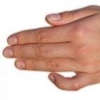 Kromme vingers of kromme vinger bij kinderen: Camptodactylie