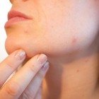 Hoe verwijder je een gerstekorrel van je huid?