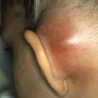 Mastoïditis symptomen: pijn achter oor, oorpijn en hoofdpijn