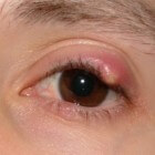 Bultje op ooglid (of bij wimper): oorzaken en symptomen