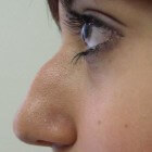 Korstjes in neus: oorzaken & behandeling van korsten in neus