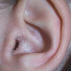 Korstje op oor of bultje op oorschelp: oorzaak & behandeling