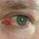 Rode ogen: oorzaken van een rood oog of ogen | Mens en Gezondheid: Aandoeningen