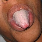 Witte tong: oorzaken en behandeling van wit beslagen tong