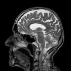 Diffuse axonale beschadiging van de hersenen