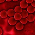 Hemolytische anemie: Voortijdige afbraak rode bloedcellen