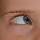Orbitale myositis: Ontsteking van spieren van oogbewegingen