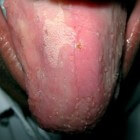 Glossitis (ontstoken tong): symptomen, oorzaak & behandeling