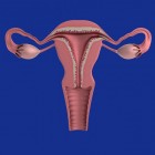 Adenomyose: Pijnlijke menstruatie door verdikte baarmoeder
