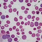 Fanconi anemie: Tekort van alle bloedcellen en afwijkingen