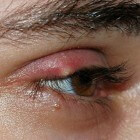 Hordeolum: Strontje (pijnlijk bultje) in of op het ooglid