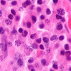 Ziekte van Kahler: Kanker van plasmacellen met botpijn