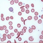 Sikkelcelanemie: Bloedaandoening van rode bloedcellen