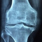 Een botkneuzing (bone bruise): symptomen en behandeling