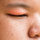 Gezwollen ooglid: oorzaak gezwollen oogleden of dikke ogen