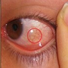 Chemosis: Zwelling van de conjunctiva (oogbindvlies)