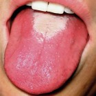 Glossitis: Ontsteking van tong met glad & rood tongoppervlak