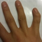 Clinodactylie: Kromming van de vingers of tenen
