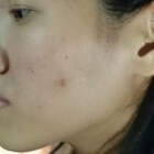 Acne: Huidaandoening met ontsteking van talgklieren