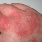 Atopische dermatitis: behandeling met zalf, crèmes en UV