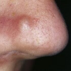 Bultje op de neus: symptomen, oorzaak en behandeling