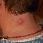Bultjes in nek: oorzaken knobbeltje of bult in nek of hals