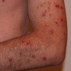 Acne excoriée: dwangmatig pulken en krabben aan het gezicht