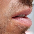 Verbrande Lippen Door Blootstelling Zon: Tips Voor Genezing | Mens En  Gezondheid: Aandoeningen