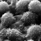 Haarcelleukemie: Bloedkanker met overmatige, harige B-cellen