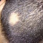 Alopecia areata: Haaruitval met ronde, kale plekken