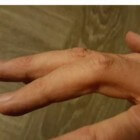 Trigger finger: vinger is moeilijk of niet meer te strekken