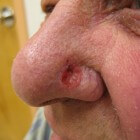 Rode neus: Oorzaken, symptomen en behandeling