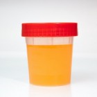 Oranje urine: oorzaken van oranje gekleurde urine of plas