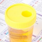 Blauwe urine: oorzaken en symptomen van blauwe urine of plas