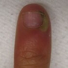 Paronychia: Ontsteking van de nagelwal (nagelriemontsteking)