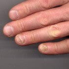 Uitroepteken labyrint plug Loslatende nagel (onycholyse): oorzaken van nagelloslating | Mens en  Gezondheid: Aandoeningen