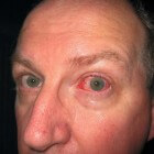 Bacteriële conjunctivitis (oogbindvliesontsteking)