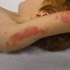Gordelroos: Infectie met huiduitslag & symptomen aan gezicht