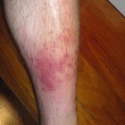 Cellulitis: Huidinfectie met rode en gezwollen huid