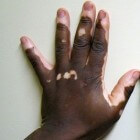 Vitiligo: Huidaandoening met witte vlekken in huid