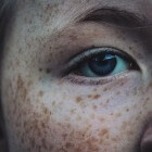 Hyperpigmentatie: Donkere vlekken in de huid
