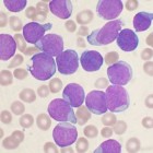 Acute lymfatische leukemie (ALL): Acute vorm van bloedkanker