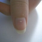 Witte vlekjes op de nagel: leukonychia oorzaak en symptomen