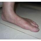 Platvoeten: Pijnloze voetafwijking met voetzool op de grond