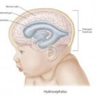 Hydrocefalie: Te veel hersen- en ruggenmergvocht in schedel